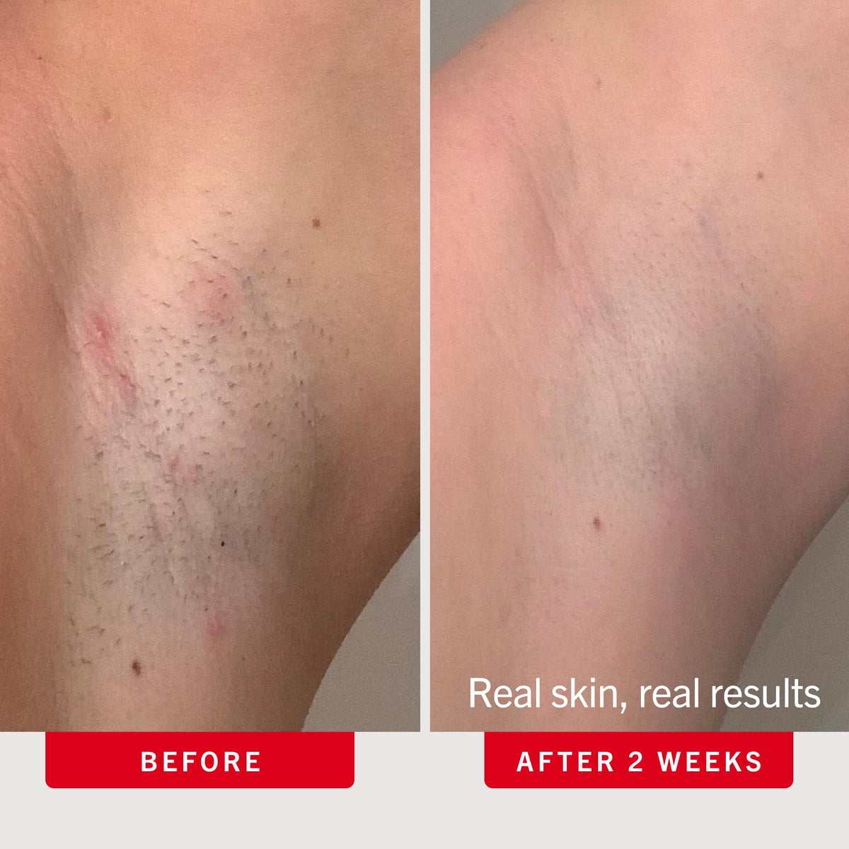 First Aid Beauty Ingrown Hair Pads with BHA and AHA